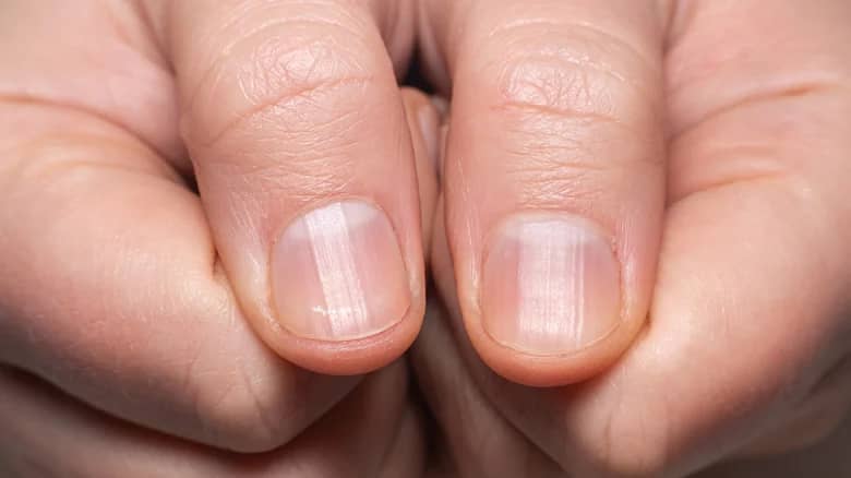 What Those Ridges On Your Fingernails Really Mean